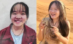 'Vịt hóa thiên nga' sau niềng răng